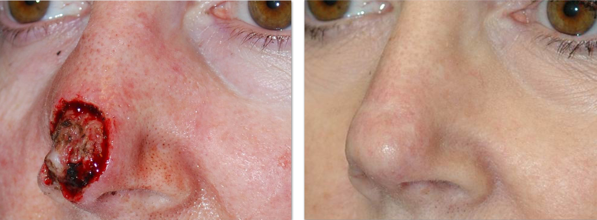 skin cancer on nose pictures