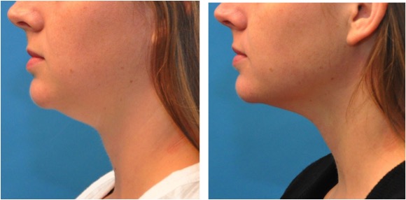 kybella-pre-and-post-6-weeks.jpg