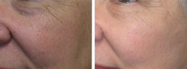 fat transfer for facial volume