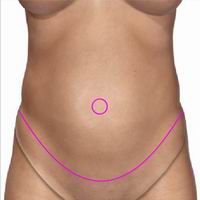 tummytuck_procedure6.jpg